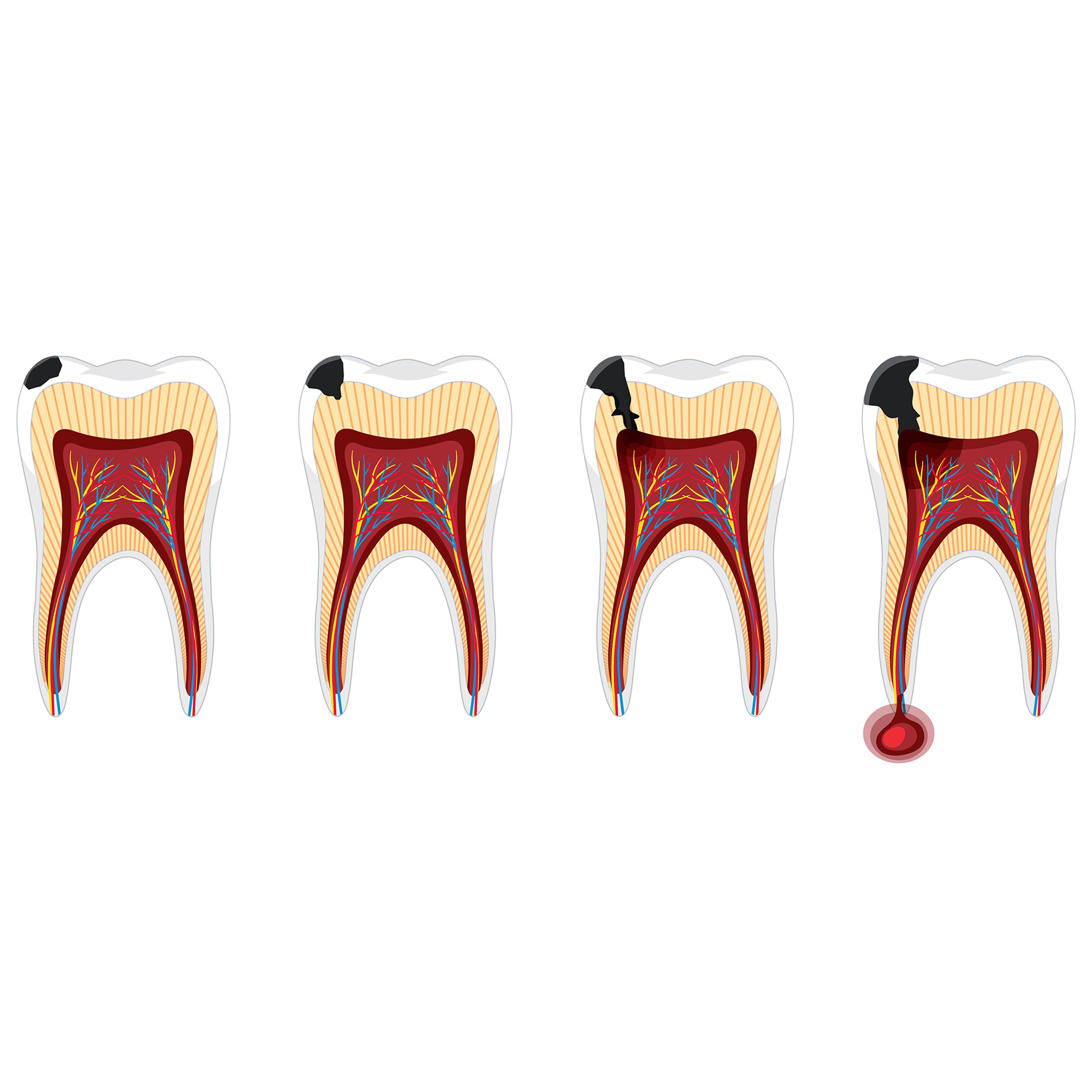 Erosione Dentale Torino